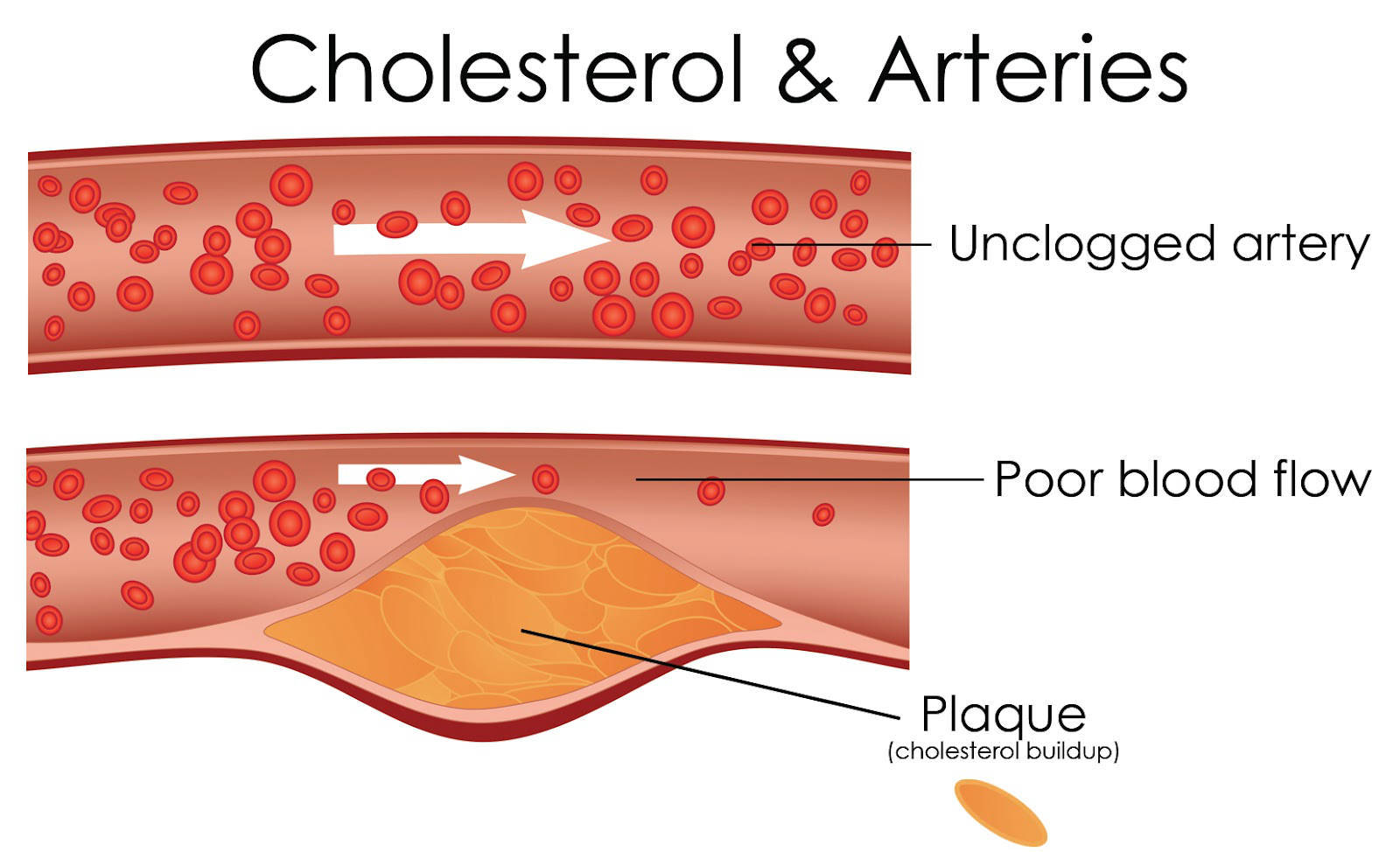 Lower Cholesterol – NEW CHOLESTEROL RELIEF FORMULA – lowers LDL – 1 Bottle